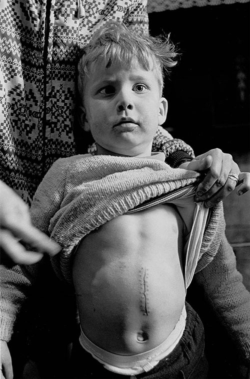 Boy and his operation scar caused by a fall on a rusty nail, Newcastle  (1971)