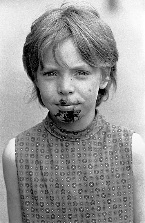 Child with impetigo caused by foul drainage, Winson Green, Birmingham  (1971)